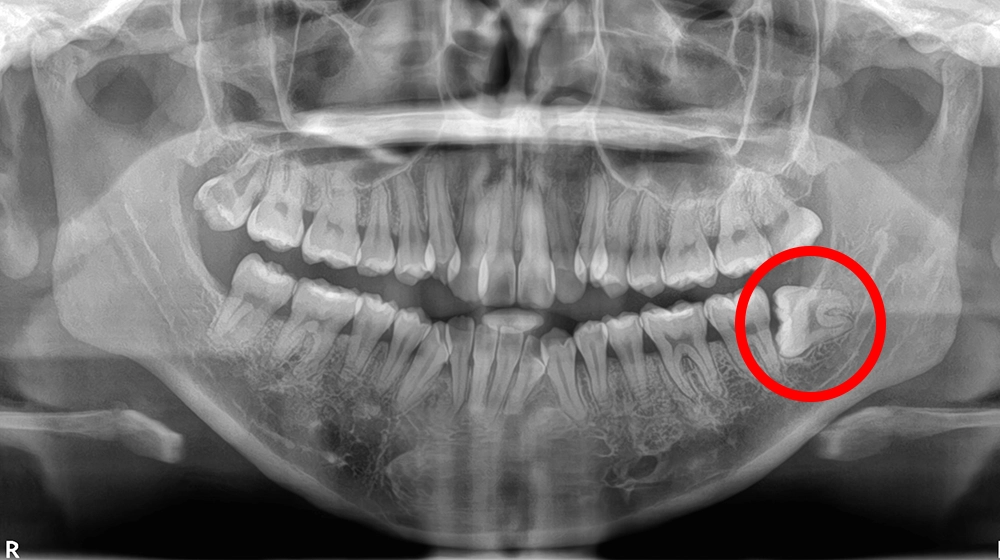 親知らず抜歯の症例写真