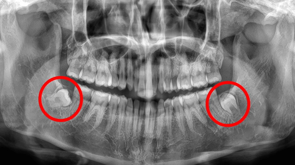 親知らず抜歯の症例写真