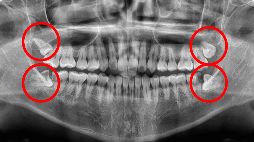 親知らず抜歯の症例写真