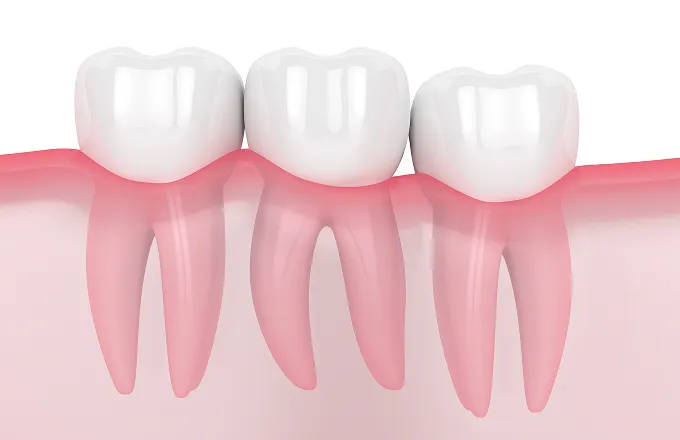 まっすぐ生えている親知らずイメージ