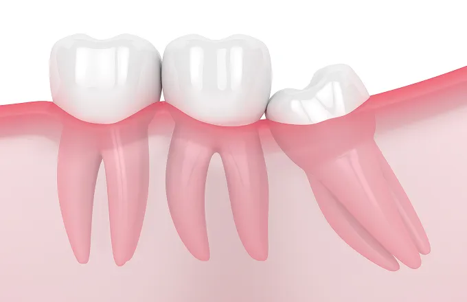 斜め／横向きに生えている親知らずイメージ