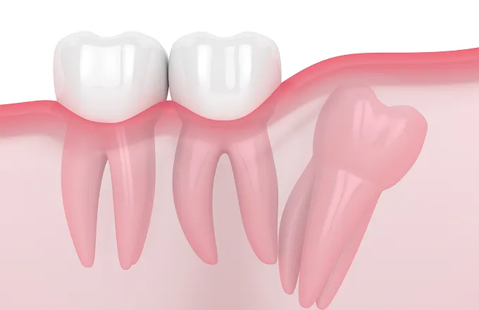 歯茎に埋まっている親知らずイメージ